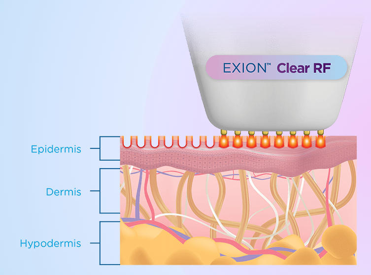 Exion Clear RF